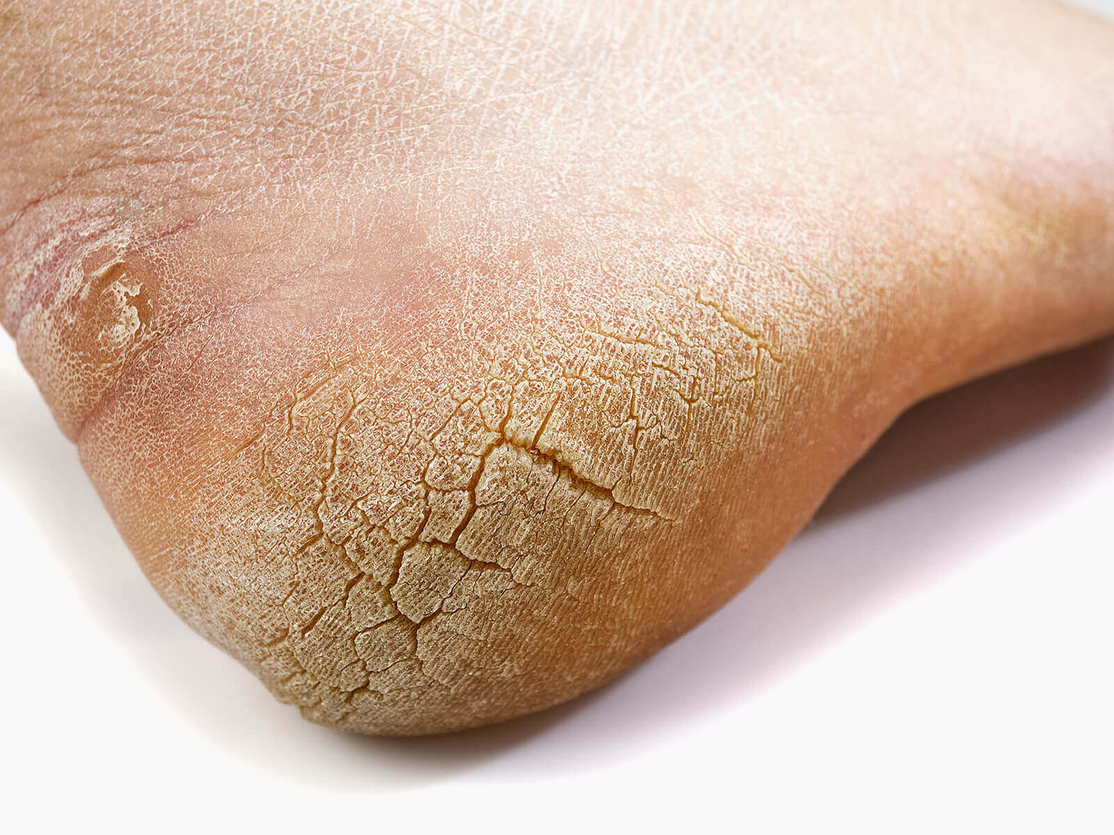 west wales podiatry callus hard skin