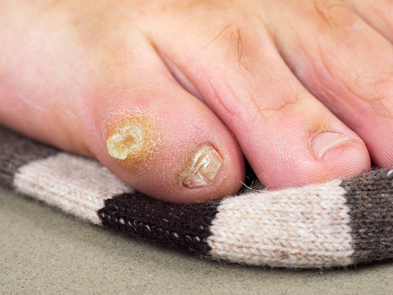 west wales podiatry corns