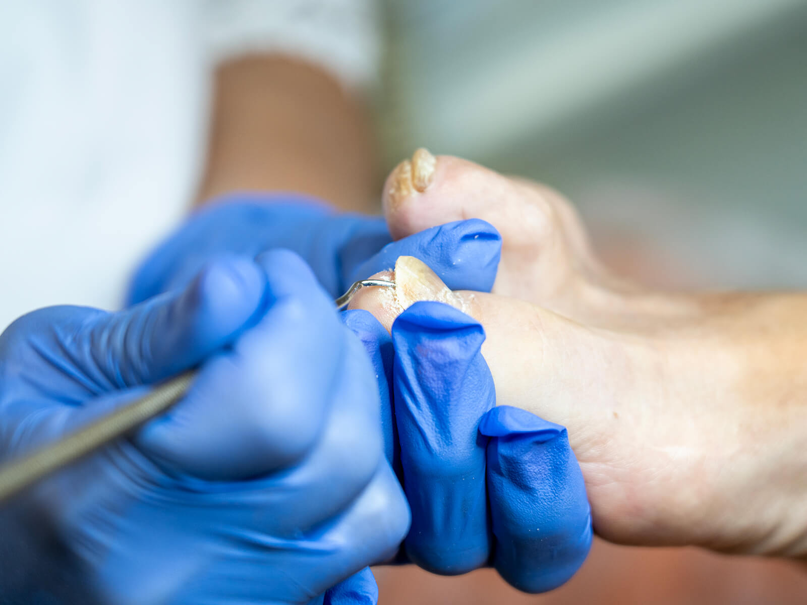 west wales podiatry fungal nail advice