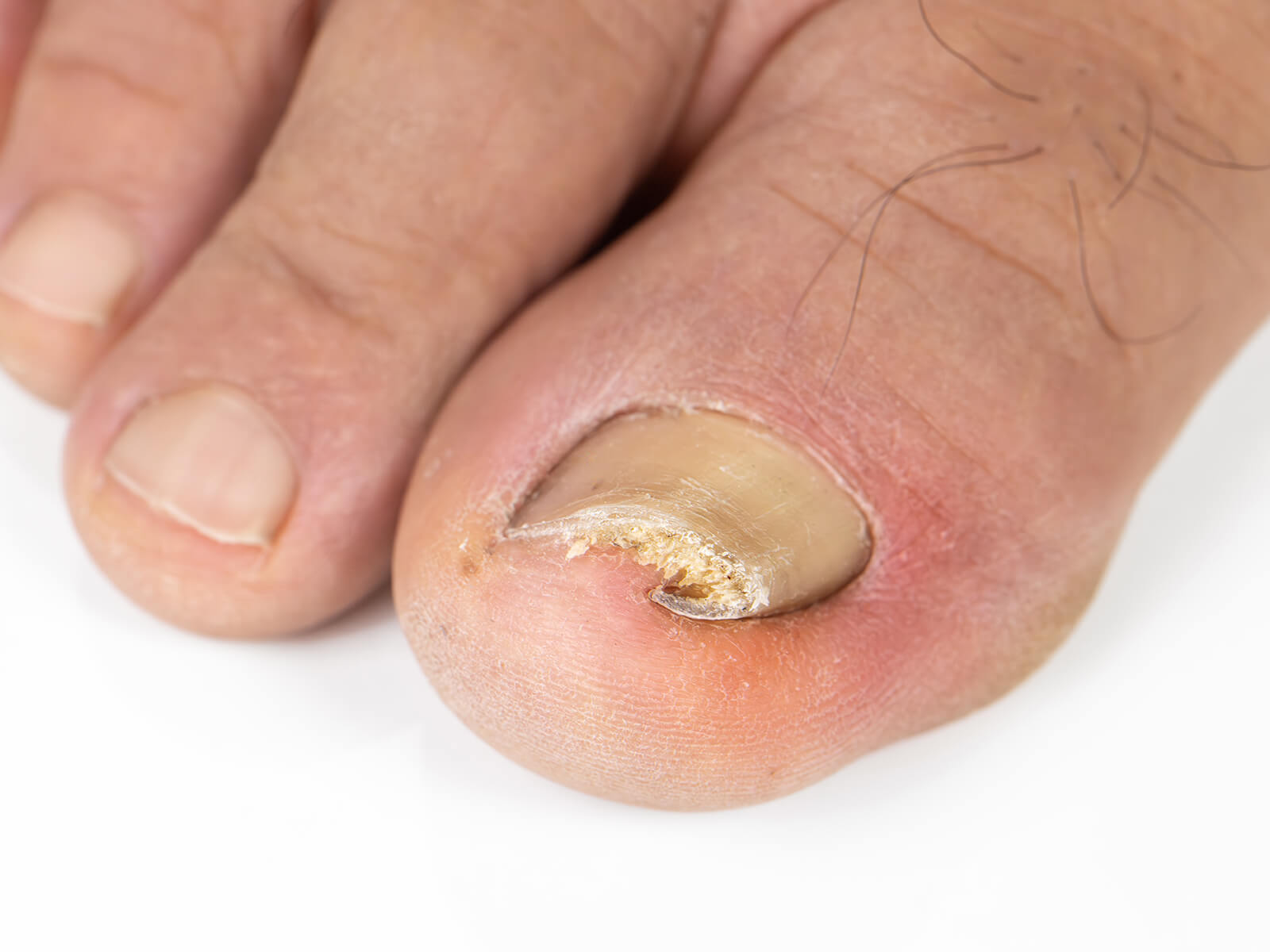 west wales podiatry ingrown toenail