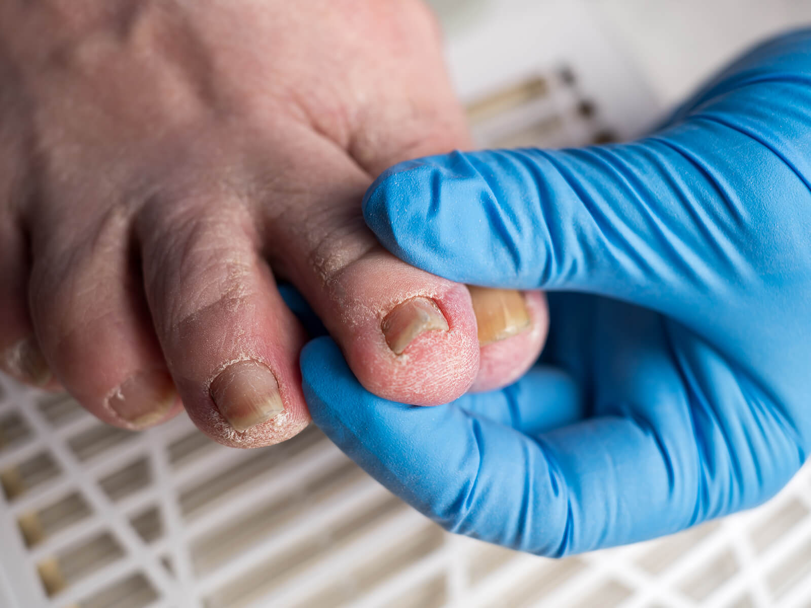 west wales podiatry ingrown toenail